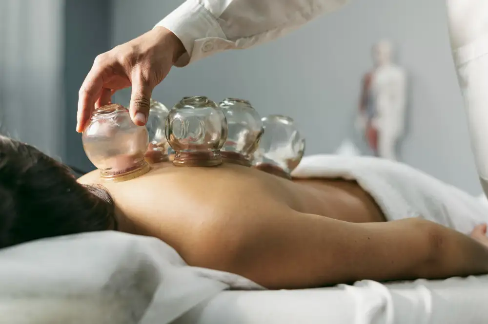 Acupuncture Mississauga cupping for Muscle tension and detox
