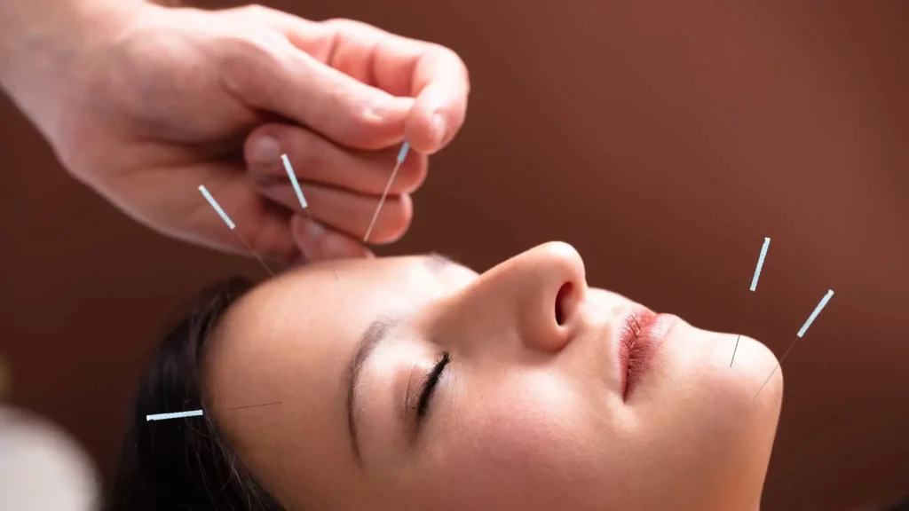 acupuncture for headache migraine acupuncture for headache migraine sculp needles