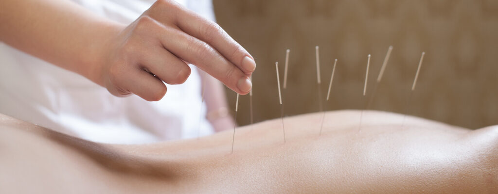 acupuncture-1218-1280x500 Acupuncture Close to me with dry needles